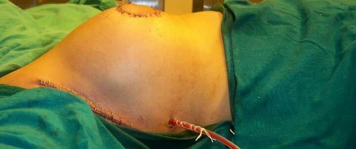 Breast Conservation Surgery in Ambegaon BK | Dr. Saurabh Mohite