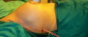 Breast Conservation Surgery in Ambegaon BK | Dr. Saurabh Mohite